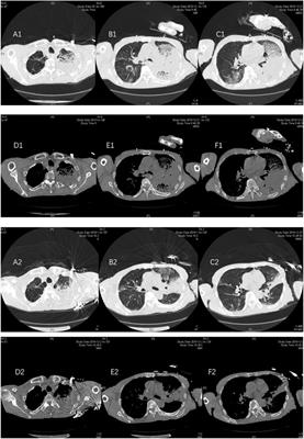 Physiological analysis of severe chlamydia psittaci pneumonia and clinical diagnosis after doxycycline-based treatment